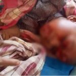 पागल कुत्ते ने 4 साल के बच्चे पर किया हमला, सिर-नाक-मुंह समेत शरीर पर 17 जगह काटा