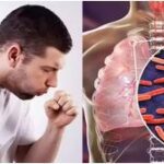 इंदौर में 4 महीनों में 3,004 नए TB मामले, 28 मरीजों की मौत; स्वास्थ्य विभाग ने जताई चिंता
